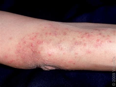 Dermatitis Herpetiformis (Duhring's disease), Salt Lake City, UT