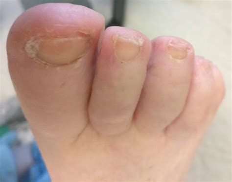 Curved Toenail Treatment - The Complete Ingrown Toenail Guide!