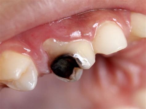 Cavities (Dental Caries). - HEALTH INFORMATION