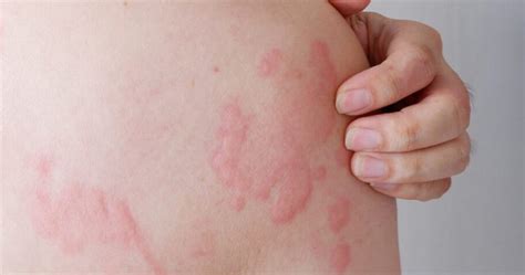 Vermelhidão E Coçeira Na Pele - Alergia de pele e calor: Como evitar sintomas e irritações na pele