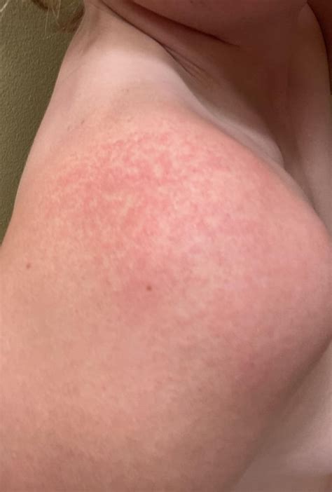 Rash photos from 75mg Lamotrigine : r/Lamotrigine