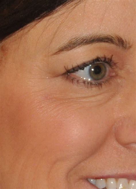 Real Patient Case: 158 | Seattle Face & Skin