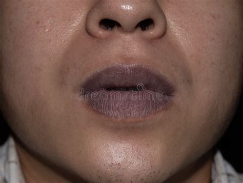 central cyanosis   lips  asian young man  congenital heart