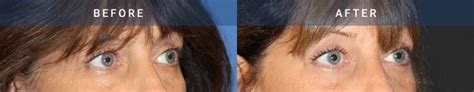 Eyelid Surgery | Ptosis Correction Case 1959 - Radiance Surgery ...