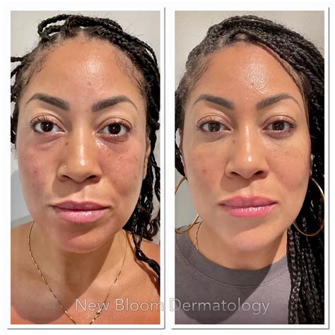 rha collection  bloom dermatology pllc