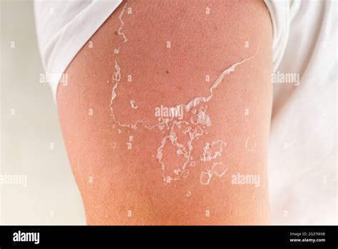 peeling of skin after burned by sunlight. not using sunscreen Stock ...