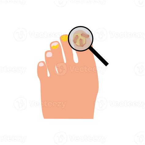 Onychomycosis. Feet with nail disease. Fungal nails infection. Doctors
