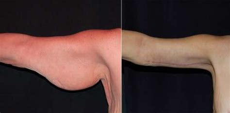 Lipo De Braço Antes E Depois - Lipo no Braço: Antes e Depois - Solução para Flacidez e Gordura