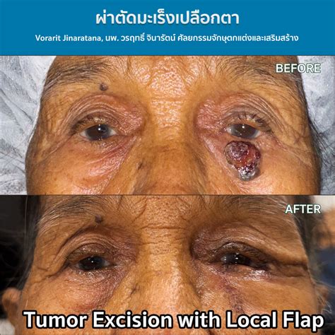 tumor  reconstructive surgery drartvoraritcom