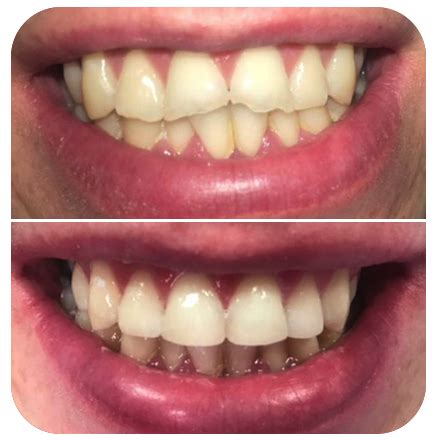 composite phibsboro dental care