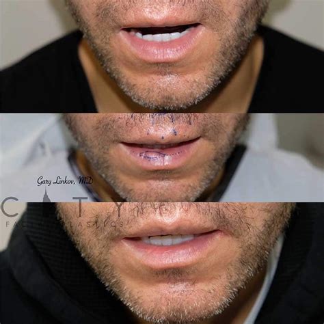 Lip Scar Tissue Lump Removal | Sitelip.org