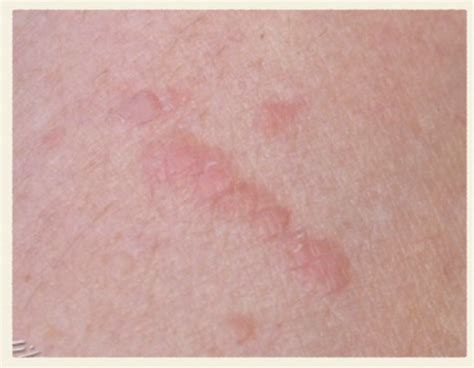 Derm - Viral Skin Infections Flashcards | Quizlet