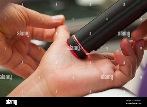 hand treatment laser hands treatments lasers stock photo alamy