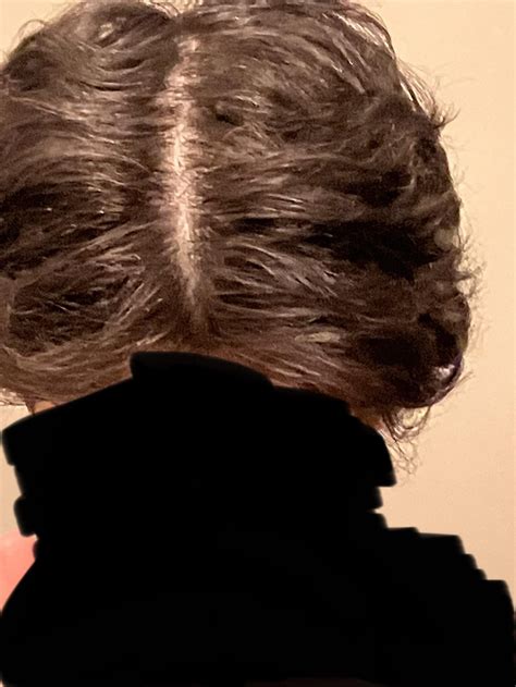 losing hair part line 8