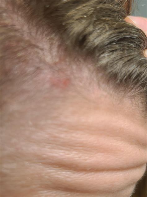 Seb derm? Used clarifying shampoo 2 days ago , thought I had buildup