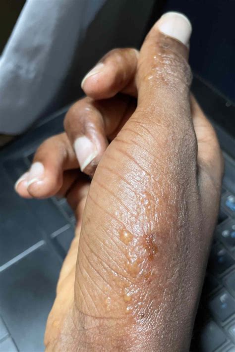 scabies   scabies pictures  pictures ptomo