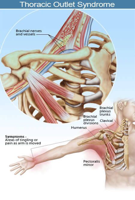 Thoracic outlet syndrome symptoms and causes – Artofit