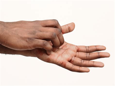 Best Hand Cream For Cracked, Red-Raw, Sore Hands – Balmonds