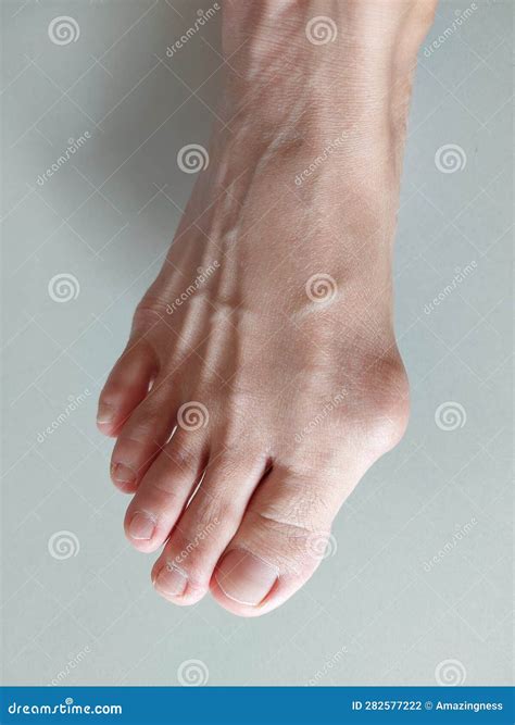 A Woman Right Foot with Hallux Valgus, Foot Bunions, Bony Bump. Stock