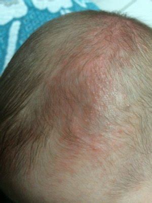 Mancha Vermelha Na Cabeça Do Bebe - Meu bebê tem uma mancha vermelha cheia de bolinhas na cabeça, será que ...