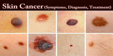 Skin Cancer (Symptoms, Diagnosis, Treatment) - Assignment Point