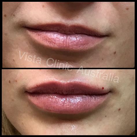 LIPS | BEFORE AND AFTER - Vista Clinic Melbourne