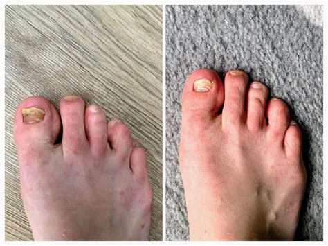 One month progress on terbinafine : r/NailFungus
