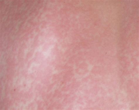 rashes images
