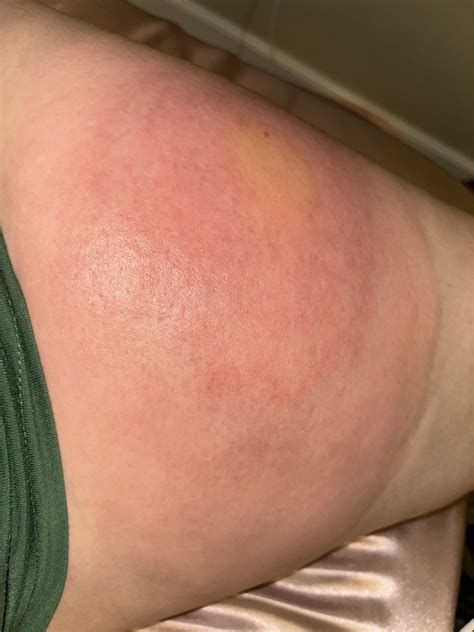 BAD Injection Site Reaction : r/Humira