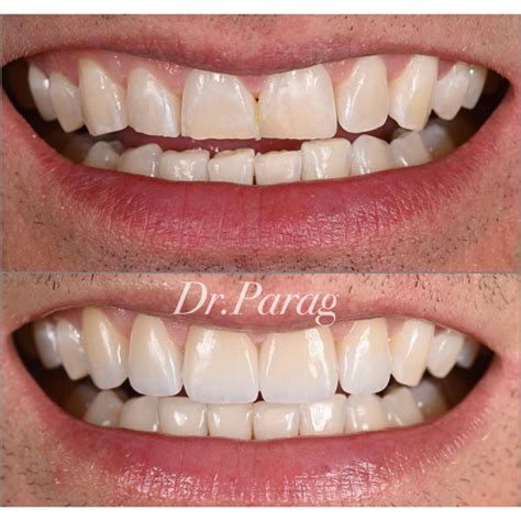 Smile Gallery - Elite Smiles