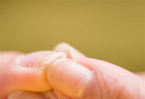 Dry Brittle Hair And Nails - Nail Ftempo