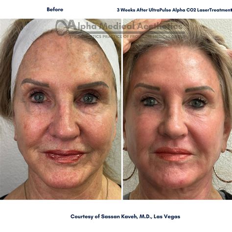 Non-Surgical Facelift in Las Vegas - Alpha Medical Aesthetics - Alpha
