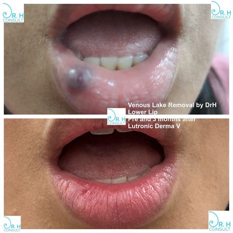 Venous Lake Lip Venous Lake Lip Removal Coventry Leicester Leamington