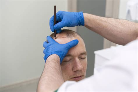 Scalp Micropigmentation: How Long Does It Last?
