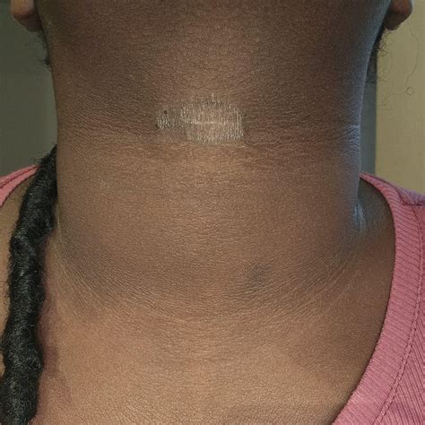 Do you guys have a clue how do get rid of this? : r/Blackskincare