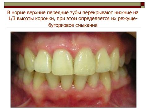 Глубокий прикус - online presentation