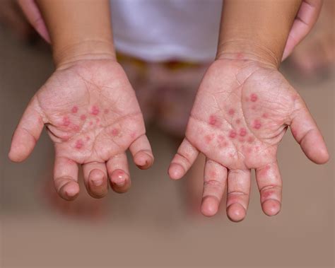 surge  hand foot  mouth disease   parent