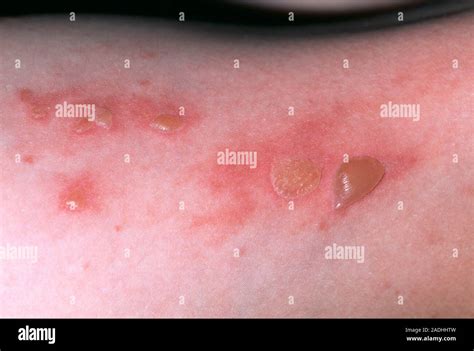 Skin infection. Blisters on a 6-year-old girl's arm from bullous