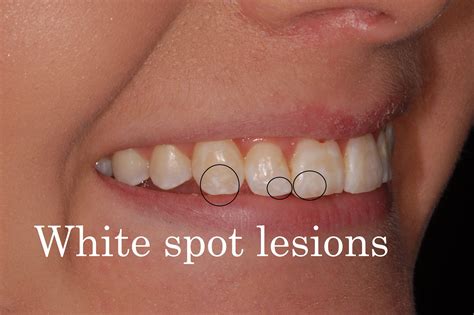 White spot lesion from braces? What can you do now?