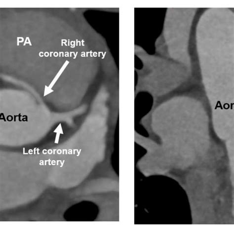 Signs of acute anteroseptal myocardial infarction on admission ...