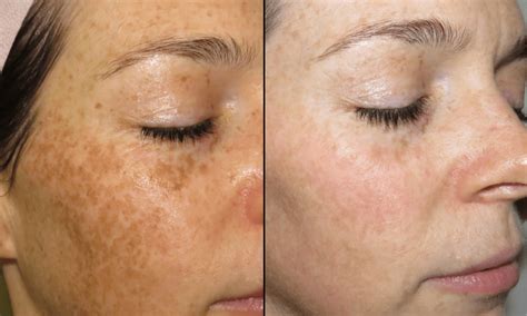 bbl laser treatment broadband light eden medical