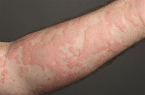 Cold Urticaria Hives Treatment at Elmo Reeves blog