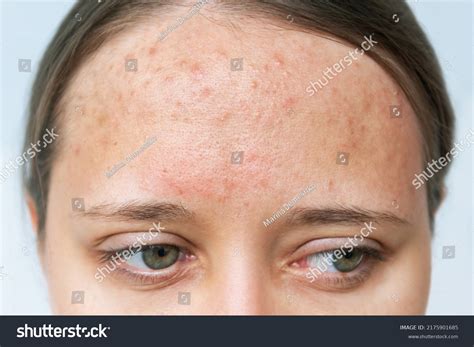 7,471 Acne Forehead Images, Stock Photos, 3D objects, & Vectors ...