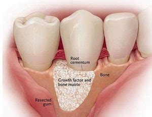 Bone Regeneration – Dentistry.com