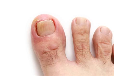 Causes of Curled Toenails - Feet First Clinic