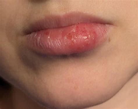 sores  lip rdermatologyquestions