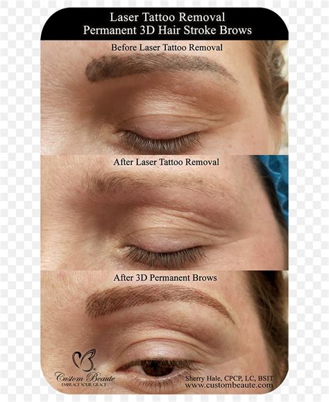 Eyebrow Tattoo Removal Permanent Makeup Laser, PNG, 667x1000px, Eyebrow ...