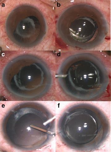 cases underwent optic capture technique   indications