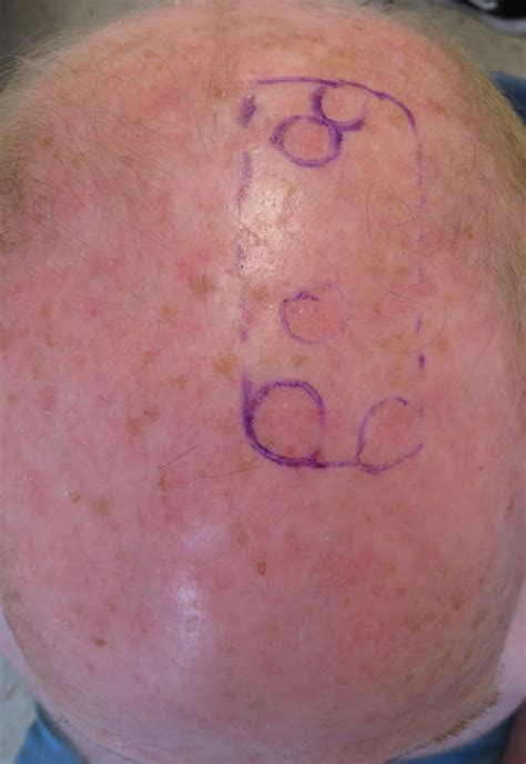 Actinic Keratosis Warning Signs and Images