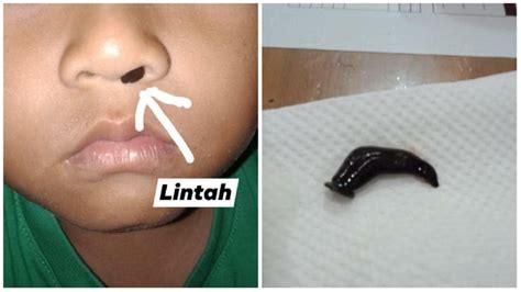 viral lintah  hidung  tua sempat perhatikan wajah anak pucat
